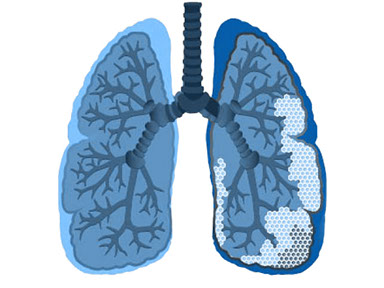 La Fibrosis Pulmonar Idiopática (FPI) es una enfermedad pulmonar rara (minoritaria y poco conocida).