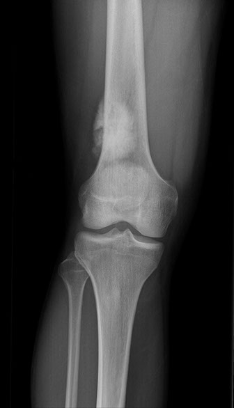 Imagen de osteosarcoma o sarcoma óseo. Consulta de Traumatología de Cape.