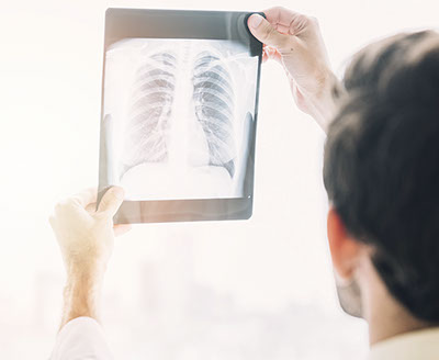 Conoce las enfermedades raras, con un acercamiento a la Fibrosis Pulmonar Idiopática